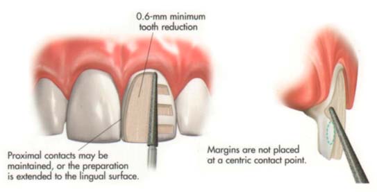 Correct prep for a veener